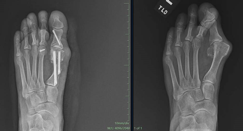 Before and After Surgery